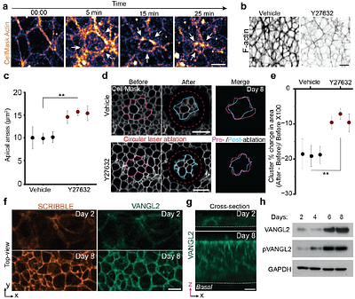 Patient-specific iPSC models of neural tube defects identify underlying deficiencies in neuroepithelial cell shape regulation and differentiation