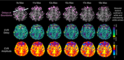 Iterative delay correction improves breath-hold cerebrovascular reactivity mapping in clinical populations