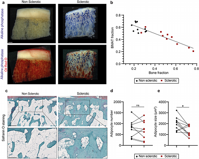 Subchondral bone remodeling in knee osteoarthritis is coupled to lipid mobilization from bone marrow adipocytes