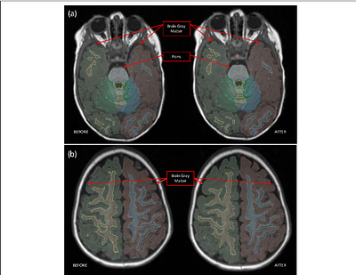 Development and Validation of Thalia: A High-ResolutionPediatric Computational Model of a 10-Month-Old Infant
