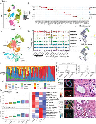 A single-cell and spatial atlas of prostate cancer reveals the combinatorial nature of gene modules underlying lineage plasticity and metastasis