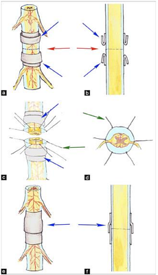 A phrenic-sparing cephalic reanastomosis model: Acute effects and implications