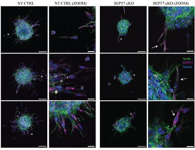 Septins promote breast cancer cell invasion in 3D collagen gels by influencing actin-based protrusion formation