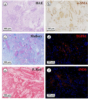 The overlooked role of muscle regeneration failure in post-implantation complications: a thorough investigation into mechanisms of recurrent urethral stricture