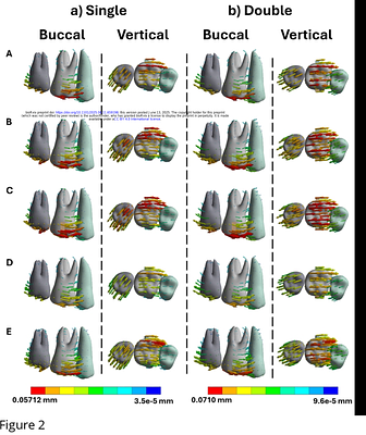 EFFECTS OF ATTACHMENT DESIGNS ON CLEAR ALIGNER TOOTH MOVEMENT: A FINITE ELEMENT ANALYSIS