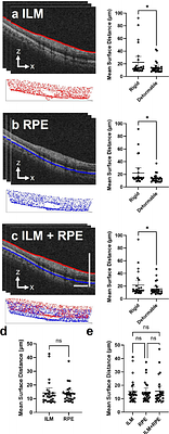 Volumetric montaging of optical coherence tomography in human retinas