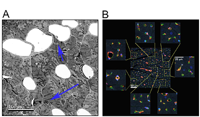 High burden of premature ventricular contractions upregulates transcriptional markers of inflammation and promotes adverse cardiac remodeling linked to cardiomyopathy