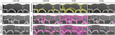 Contextual High-throughput 3D Volume Electron Microscopy Data Acquisition Using Artificial Intelligence