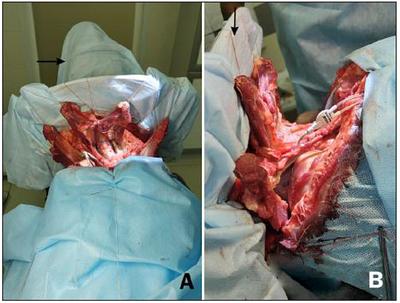 A phrenic-sparing cephalic reanastomosis model: Acute effects and implications