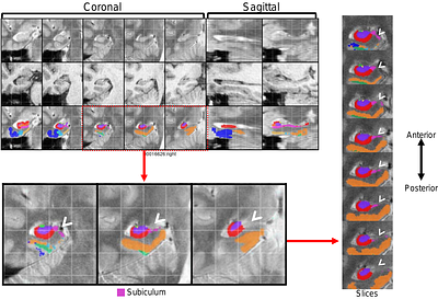 A (Sub)field Guide to Quality Control in Hippocampal Subfield Segmentation on High-resolution T2-weighted MRI