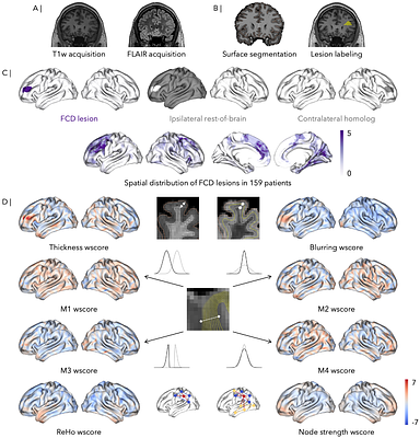 Multiscale alterations and cortex-wide organizational trends in focal cortical dysplasia