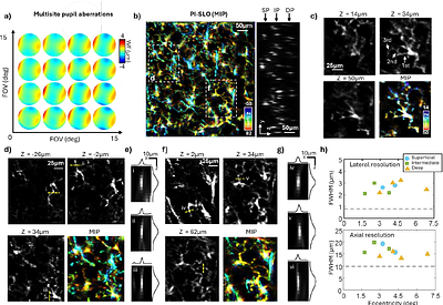 Computational aberration-corrected volumetric imaging of single retinal cells in the living eye