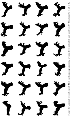 A Computational Framework for Pulmonary Assessing Wave Intensity Following Simulated Lung Resection