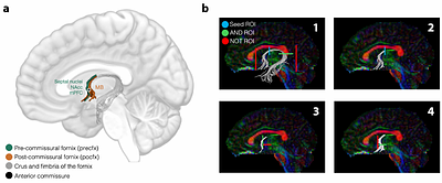 Fornix subdivisions and spatial learning: a diffusion MRI study