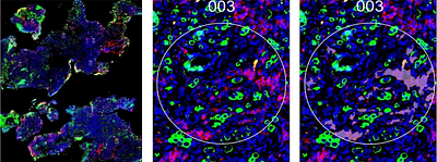 Site-Specific Immune and Stromal Architecture Drive Resistance to Trastuzumab Deruxtecan in HER2+ Metastatic Breast Cancer