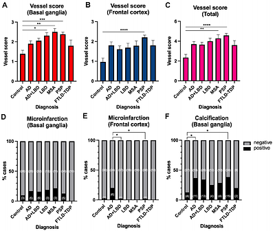Microvascular pathology of proteotoxic endothelial signature characterizes Progressive Supranuclear Palsy