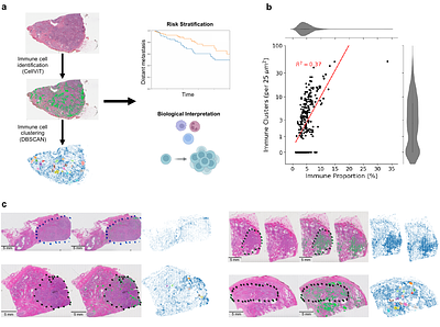 Immune Spatial Organization Predicts Metastasis Risk in Aggressive Localized Prostate Cancer