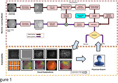 Explainable AI-Driven Diagnosis Model for Early Glaucoma Detection Using Grey-Wolf Optimized Extreme Learning Machine Approach