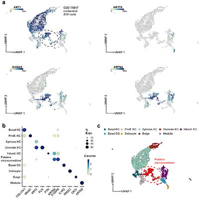 Unraveling the Comedone Switch through Single-Cell Resolution of Human Acne Lesions