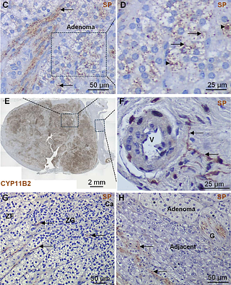 Regulation of Aldosterone Secretion by Substance P and the NK1 Receptor in Aldosterone-Producing Adenomas