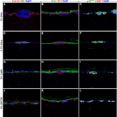 An organotypic in vitro model of human papillomavirus-associated precancerous lesions allowing automated cell quantification for preclinical drug testing