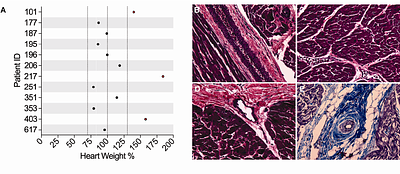 Cardiac defects in spinal muscular atrophy and the role of SMN in cardiomyocyte homeostasis