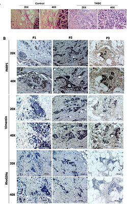 PARP1 inhibition regulates tumor progression through modulation of RhoGDIα and vimentin in triple negative breast cancer