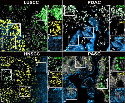 Cyclic immunofluorescence platform using photocleavable linkers for direct antibody labeling enables cancer phenotyping