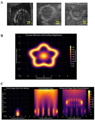 Optimal Transport Model for Gas Migration in Pneumatosis Intestinalis