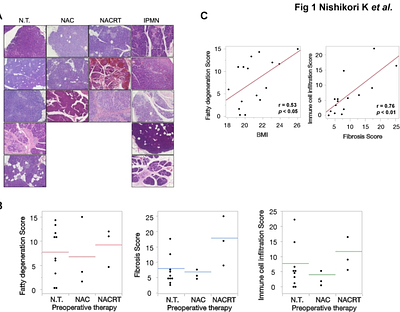Enterococcus faecalis is involved in the progression of the early stages of latent chronic pancreatitis surrounding pancreatic cancer tissue