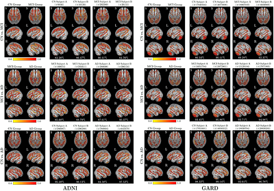 A Quantitatively Interpretable Model for Alzheimer's Disease Prediction
  Using Deep Counterfactuals