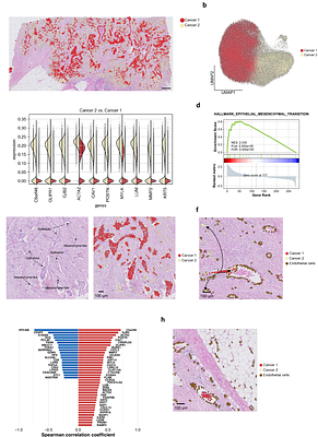 Decoding spatial organization maps and context-specific landscapes of breast cancer and its microenvironment via high-resolution spatial transcriptomic analysis