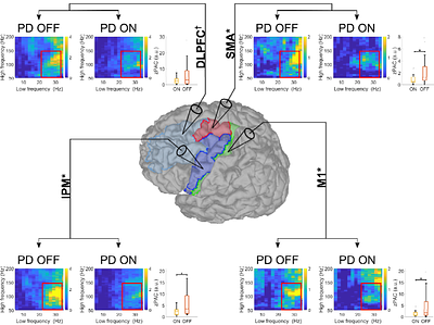 Characterizing the frequency-specific and spatiotemporal dynamics of β-γ Phase-Amplitude Coupling in Parkinson's disease