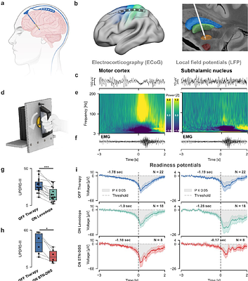 Dopamine and neuromodulation shorten the latency from motor intention to execution in Parkinson's disease