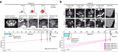 Early initiation of small intestine neuroendocrine tumors