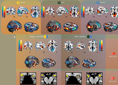 Disrupted Emotional Neural Synchrony in Schizophrenia Revealed by Intersubject Correlation of Naturalistic fMRI