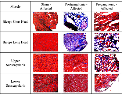 Bone Mineralization and Metabolism are Altered in a Rat Model of Brachial Plexus Birth Injury