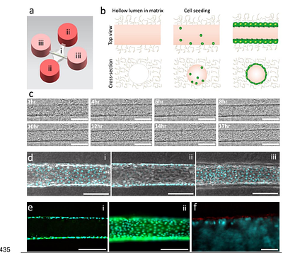 A breast Duct-on-Chip model for emulating invasive ductal carcinoma and testing therapies
