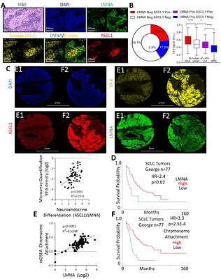 Lamin A/C Deficiency Drives Genomic Instability and Poor Survival in Small-Cell Lung Cancer through Increased R-loop Accumulation