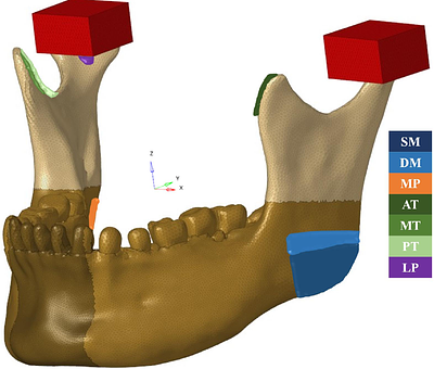 Influence of simplifications on FE modelling of mandible and TMJ implants