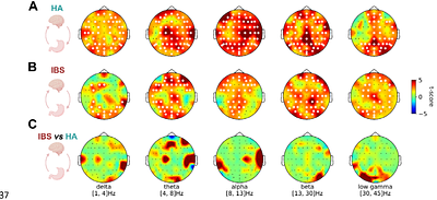 Gastric-brain coupling dynamics in response to a cognitive challenge reveal distinct autonomic and psychological correlates in healthy individuals and patients with irritable bowel syndrome