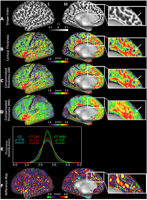 Compensating Cortical Thickness for Cortical Folding-Related Variation