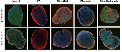 Combination of alpha-synuclein aggregation inhibitor anle138b and ER stress inhibitor AMG PERK 44 increases neuroprotection in Parkinson's disease organoid model