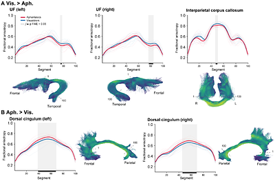 Fronto-temporal structural alterations in congenital aphantasia