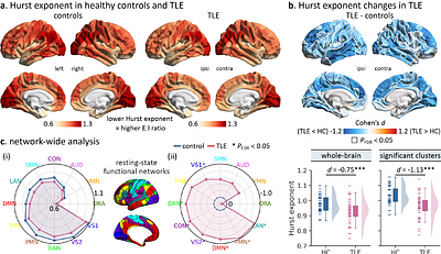 Pharmaco-resistant temporal lobe epilepsy gradually perturbs the cortex-wide excitation-inhibition balance