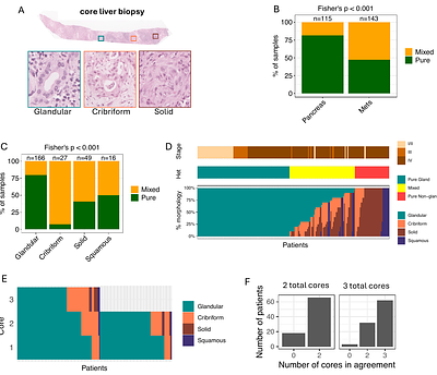 Transcriptomic, Genomic, and Clinical Characterization of Morphological Classes in Localized and Metastatic Pancreatic Cancer