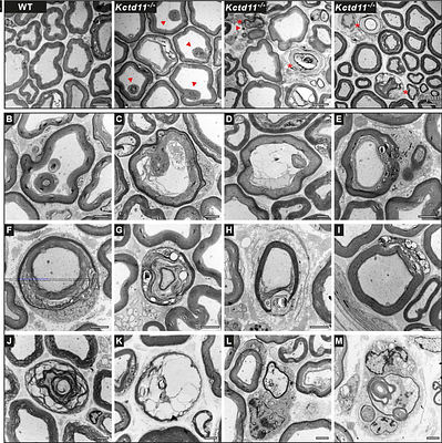 Bi-allelic mutations in KCTD11 cause a new form of autosomal recessive intermediate Charcot-Marie-Tooth disease