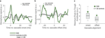 Hearing sounds when the eyes move: A case study implicating the tensor tympani in eye movement-related peripheral auditory activity